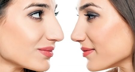 Как происходит коррекция носа с помощью ринопластики?
